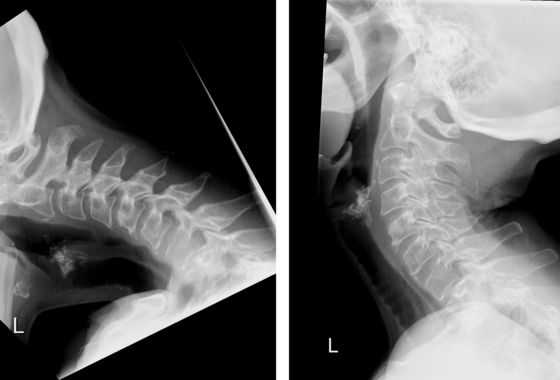 Zwei präoperative Röntgenbilder des Halses einer Patientin mit dem Dropped Head Syndrom.